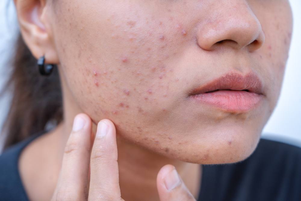 can semaglutide cause breakouts Does Dermaplaning Acne? does semaglutide make your face